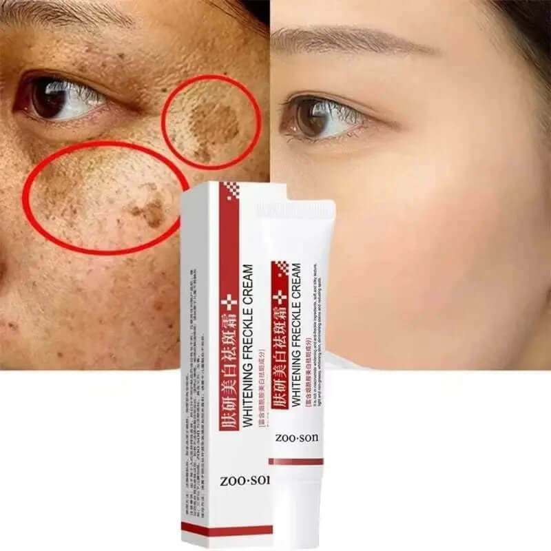 Whitening Freckle Cream with Niacinamide reducing dark spots and freckles for clear skin
